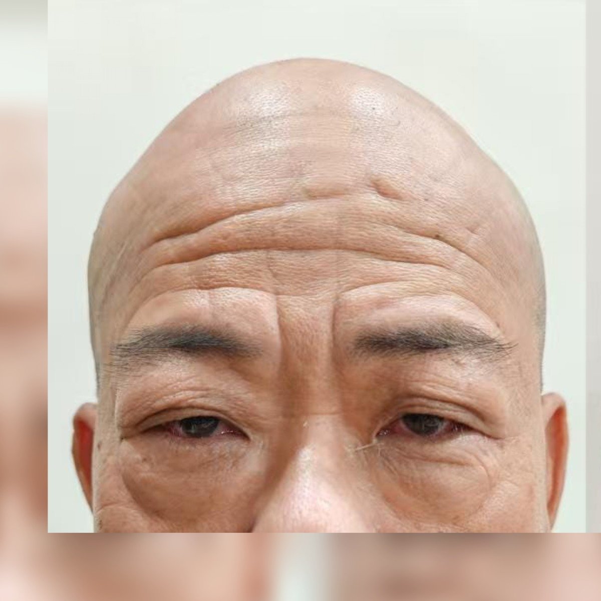 Sebelum: 1次的祛皱抬头纹