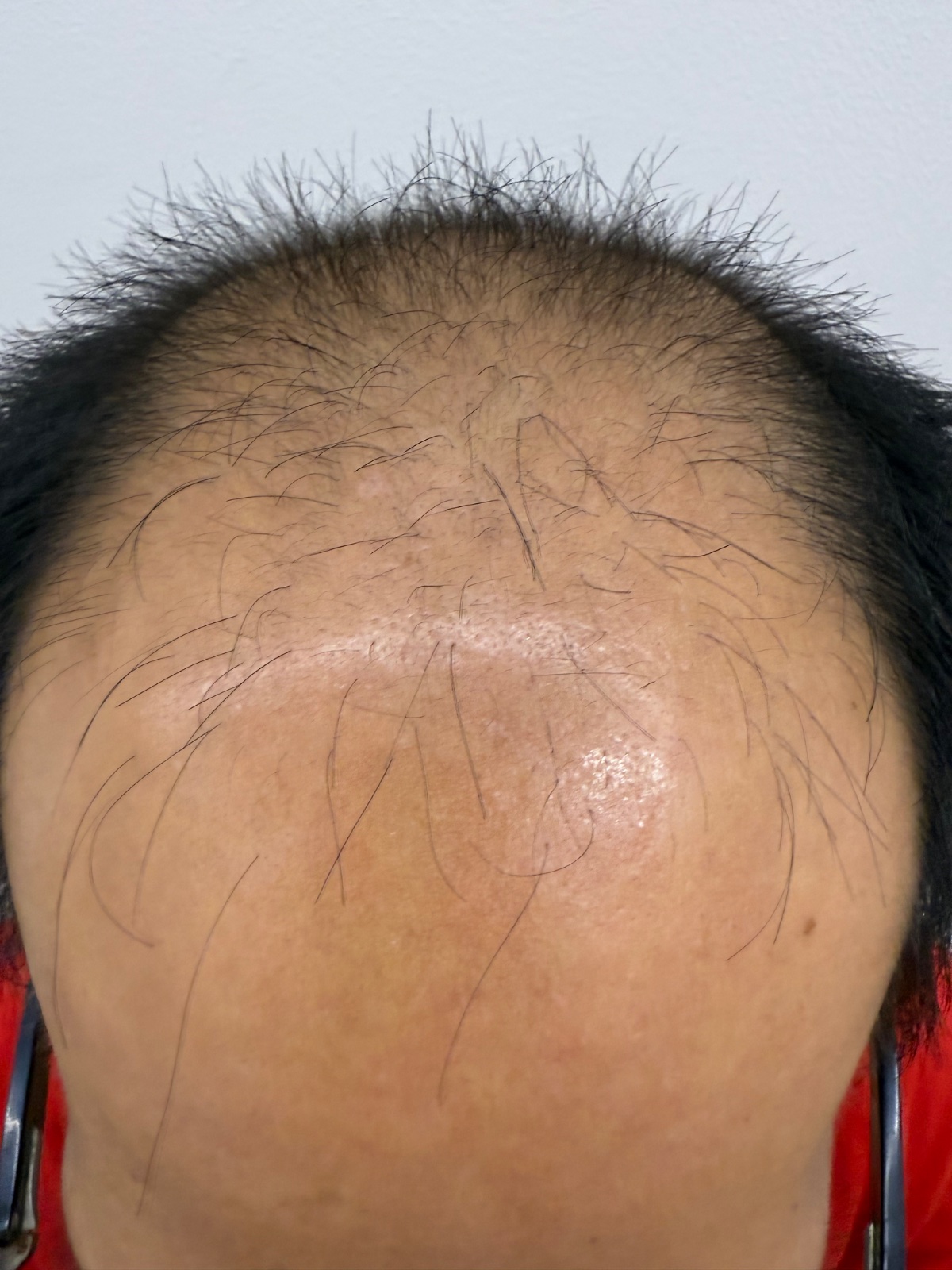 Before: Hair Folicle Activation