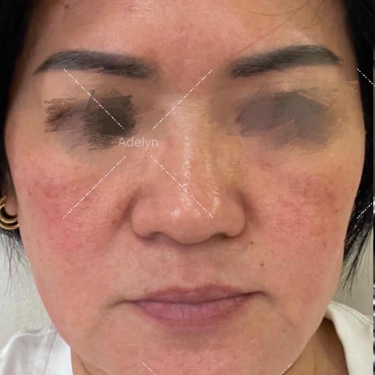 Sebelum: Repair skin barrier