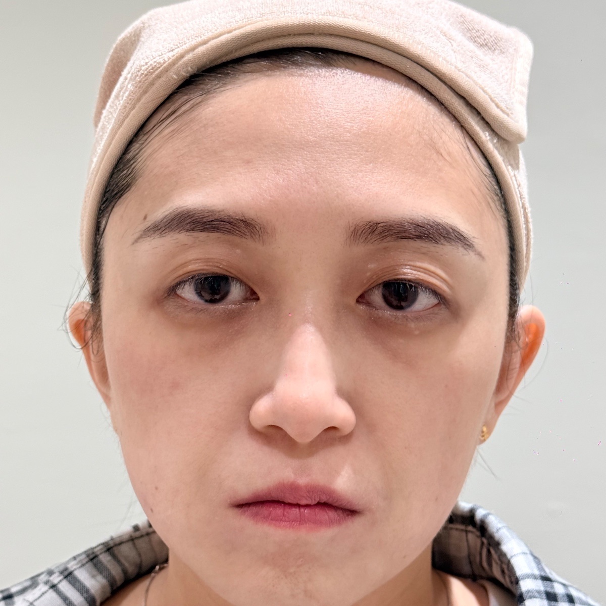 After: 3次疗程后 眼袋淡化(家族遗传眼袋问题)、皮肤色素沉淀