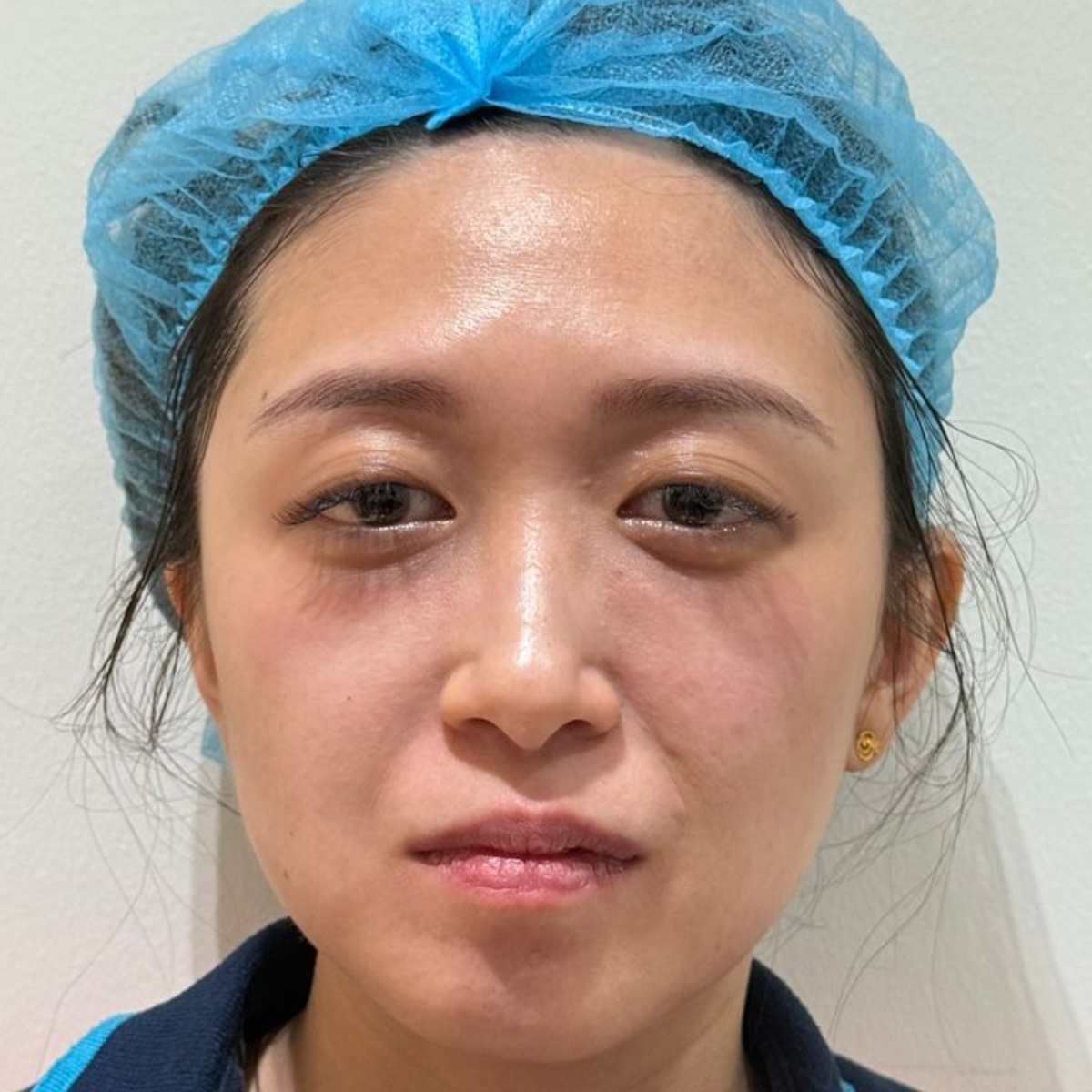 Before: 3次疗程后 眼袋淡化(家族遗传眼袋问题)、皮肤色素沉淀