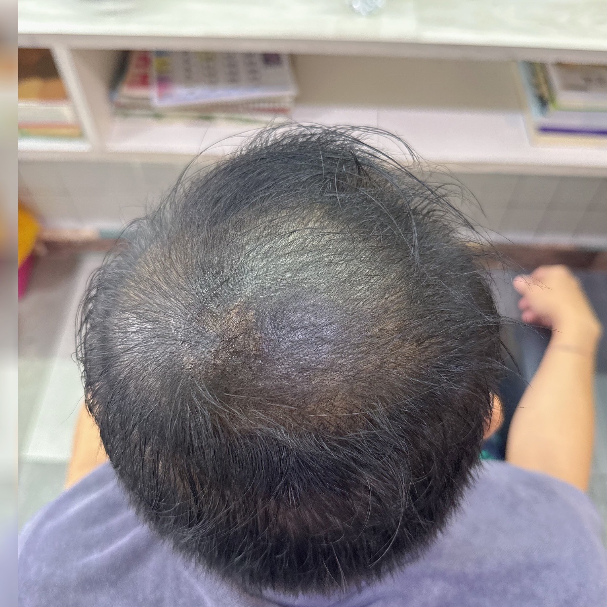 Selepas: Hair Restoration