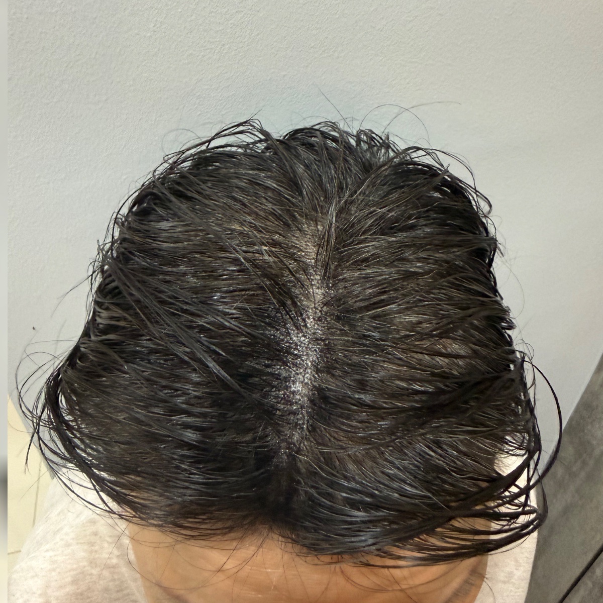 After: Hair Restoration