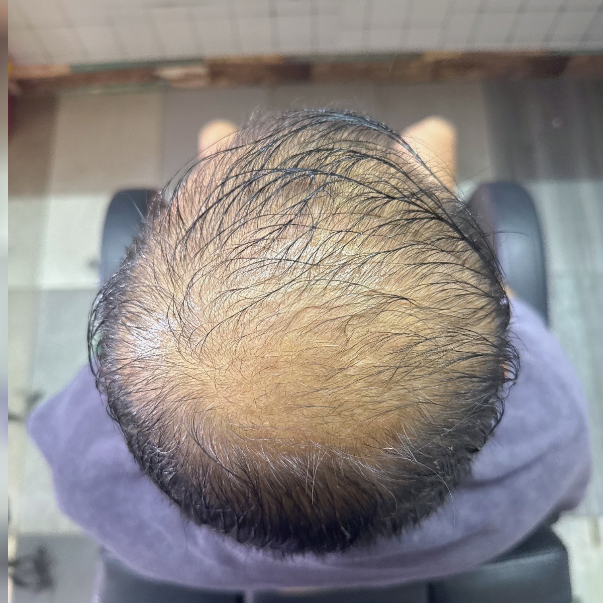 Sebelum: Hair Restoration