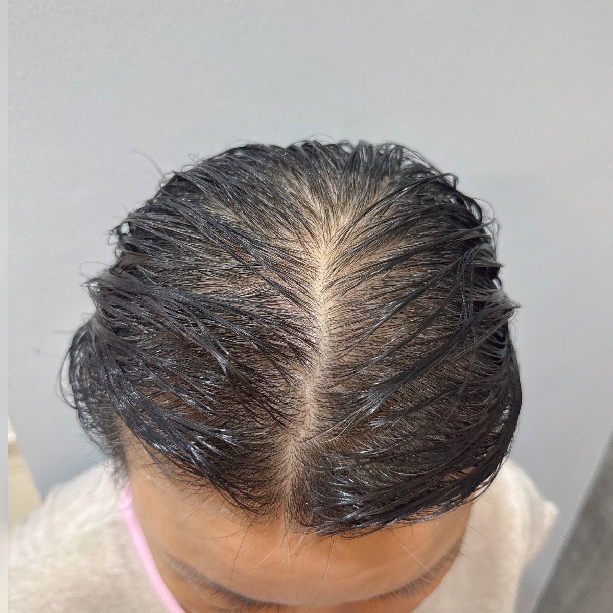 Before: Hair Restoration