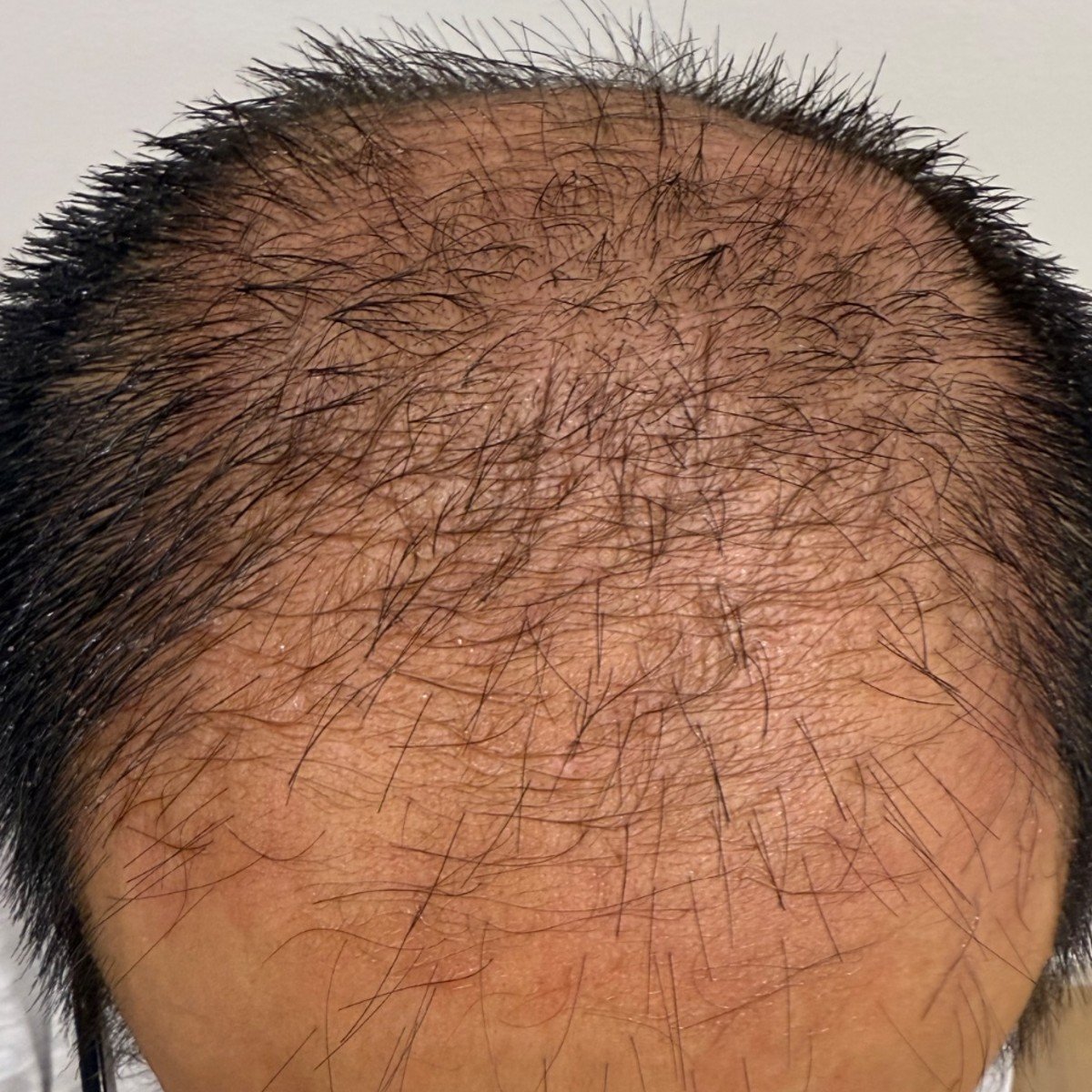 After: Hair Folicle Activation