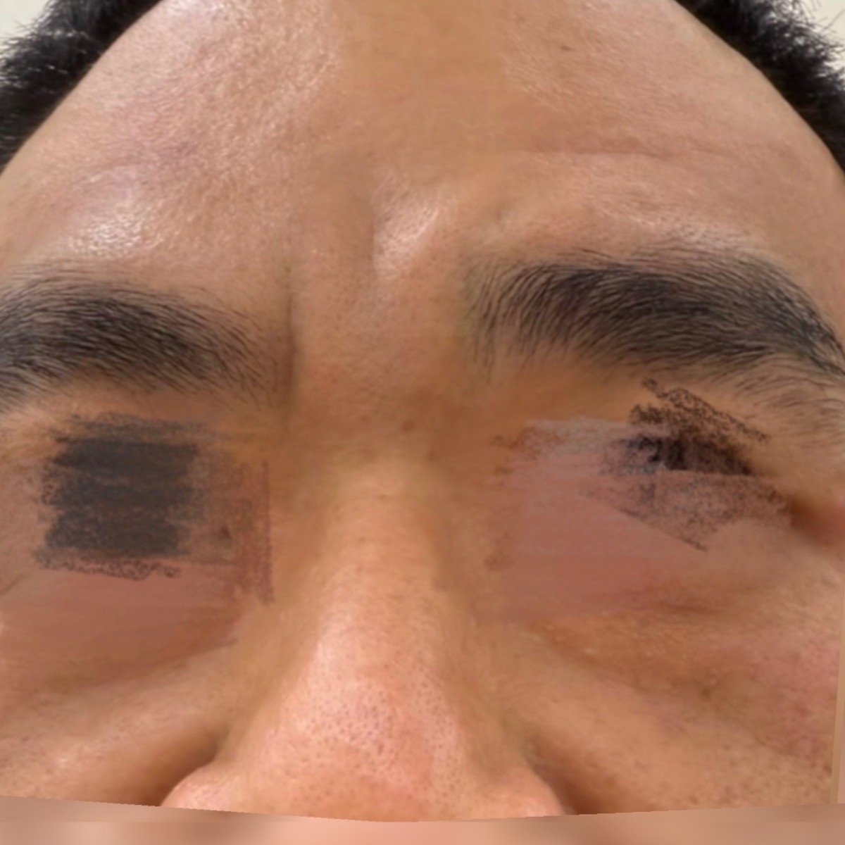 After: Wrinkle Removal 祛皱