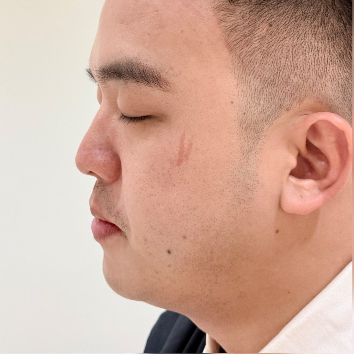 Selepas: 改善双下巴和毛孔粗大问题