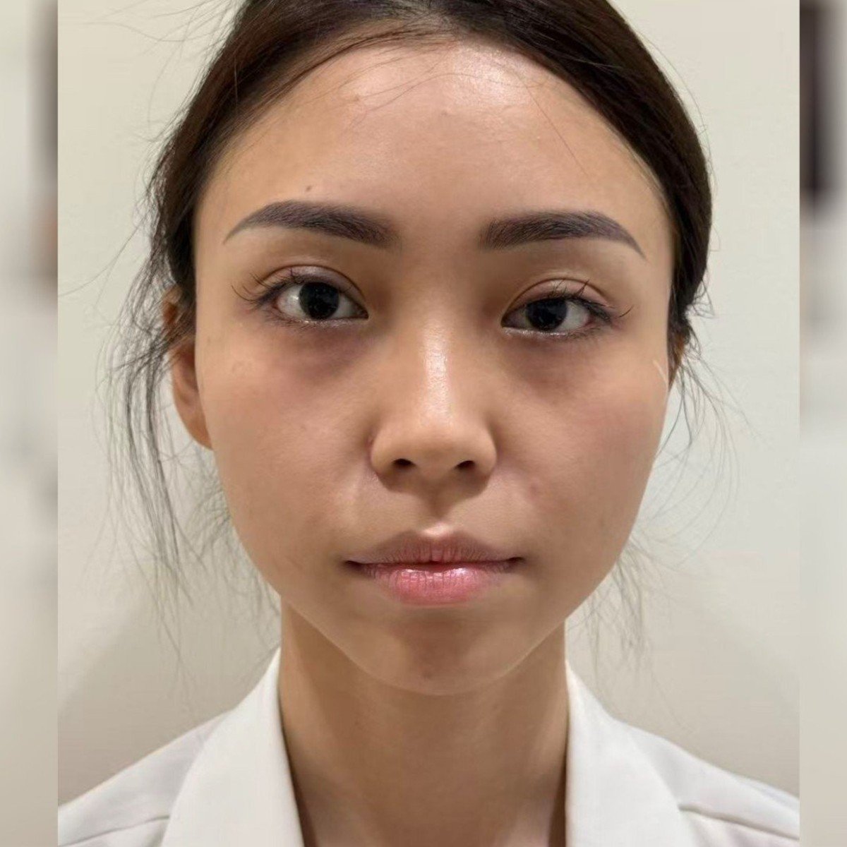 APPLE YEO CHEW PING · Before